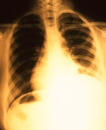 Approvato necitumumab per ca polmonare non a piccole cellule